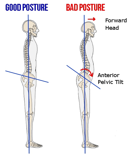 FE Greetings from Nolandia anterior-pelvic-tilt